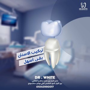 تركيب الاسنان بقى أسهل copy